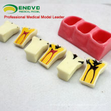 TOOTH02(12575) Oral Cavity Teeth Caries Decomposition Model / Caries Study Models in 6 parts